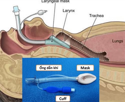 Application of laryngeal mask in anesthesia