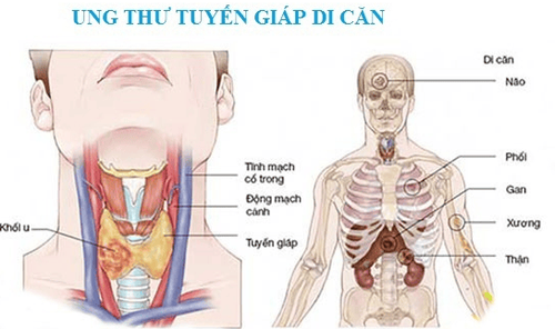 
Ung thư tuyến giáp di căn là một ung thư hiếm gặp
