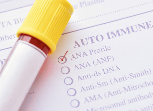 Antinuclear antibody (ANA) test diagnoses lupus erythematosus