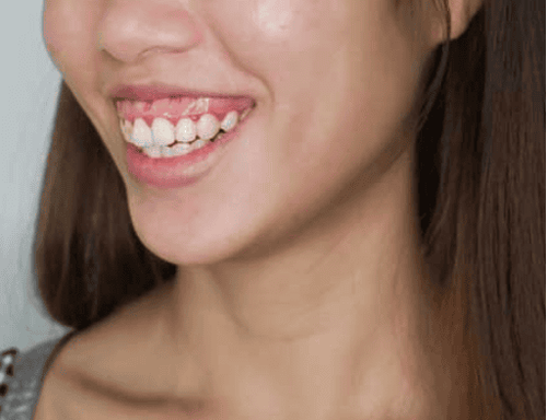 Will my gums be exposed after wearing braces?