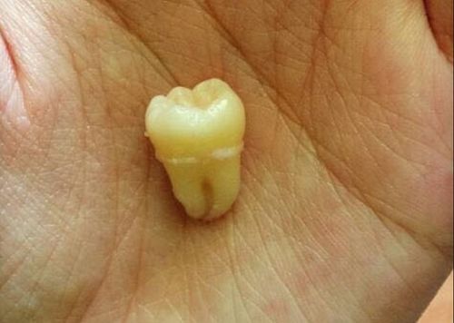 Răng còn nguyên vẹn sau gãy liệu có thể cấy vào vị trí cũ được không?