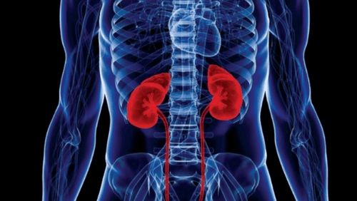 Advice on kidney transplantation for people with end-stage chronic kidney failure