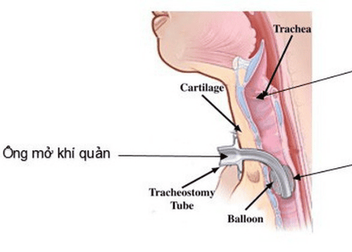 
Lỗ mở khí quản cần được thay băng thường xuyên mỗi ngày
