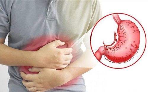 Having a history of gastritis, cough, burning, back pain is a sign of gastroesophageal reflux disease?