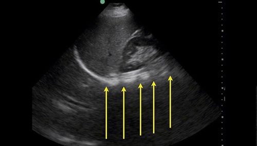 In what cases is a pleural ultrasound indicated?