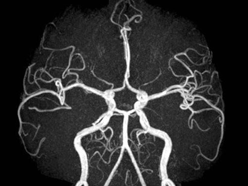 
AVM thường được chẩn đoán nhờ sự kết hợp của chụp cộng hưởng từ (MRI) và chụp mạch máu
