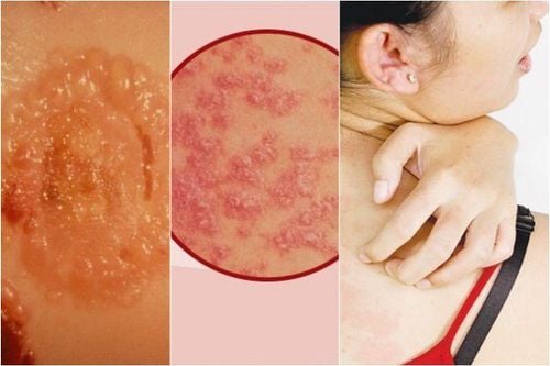 Bệnh Pemphigus: Nguyên nhân, triệu chứng và cách điều trị