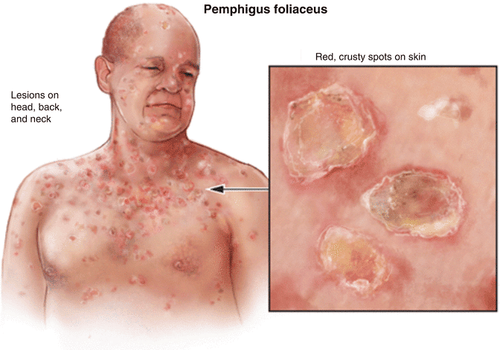 
Pemphigus vảy lá
