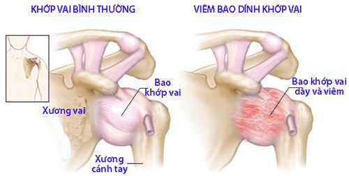 Viêm khớp: Nguyên nhân, triệu chứng, chẩn đoán và điều trị