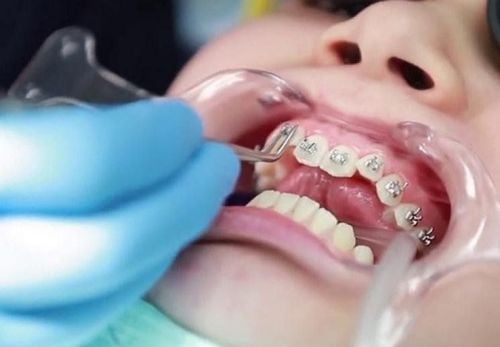 Quá trình niềng răng và cách chăm sóc sau niềng như thế nào?
