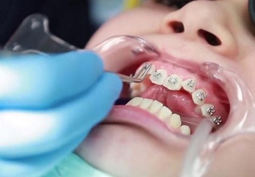 Niềng răng có làm răng bị yếu không?