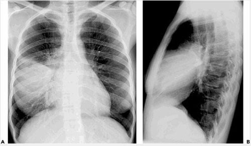 Tìm hiểu hội chứng đông đặc phổi