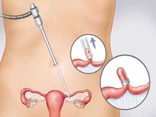 The contraceptive method with the fewest side effects ultimately depends on the individual.