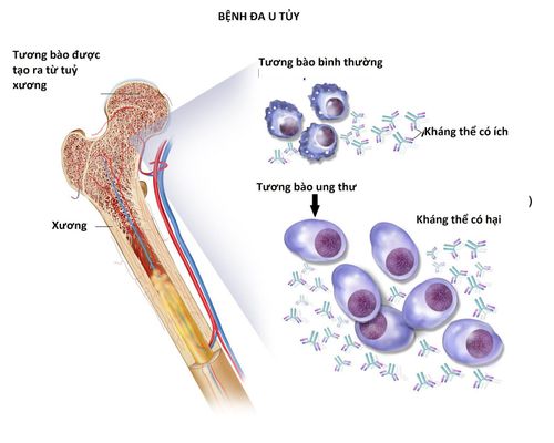 Diagnosis – Staging multiple myeloma