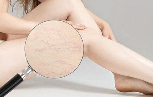 Does puberty stretch marks go away?