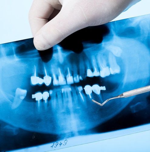 In which cases is a dental X-ray indicated?