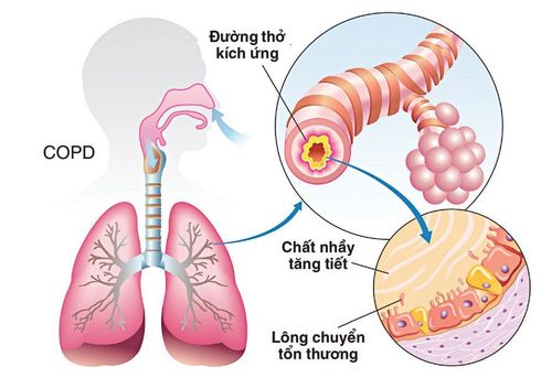 Thông khí, sạch đờm ở người bệnh mắc phổi tắc nghẽn mãn tính COPD