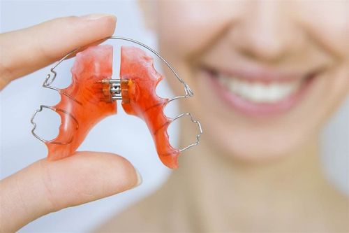 How to clean the retainer after braces?