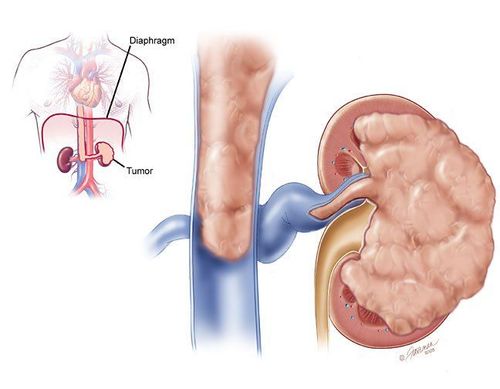 Risk factors for kidney cancer