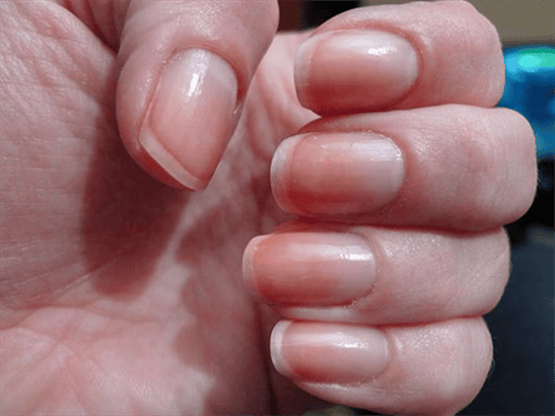 What do your nails say about your health?