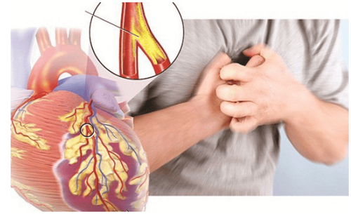 
Cholesterol và các chất béo sẽ tích tụ và hình thành những mảng xơ vữa dẫn đến tắc động mạch cảnh
