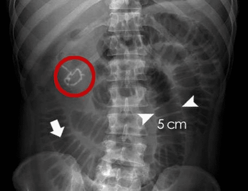 What does an X-ray of the small intestine show?