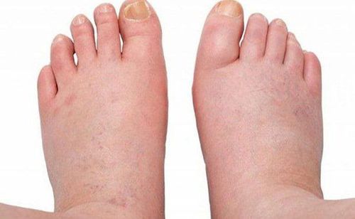 Phù có thể xảy ra ở nhiều nơi trên cơ thể, thường gặp nhất là ở chân và bàn chân.