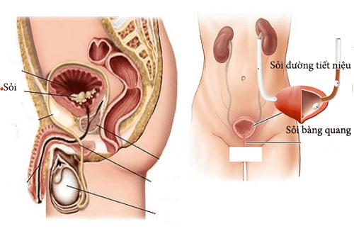 
Sỏi đường tiết niệu là nguyên nhân suy thận sau thận
