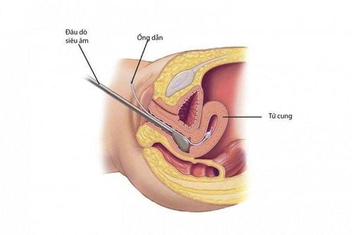 Ultrasound combined with intrauterine infusion Sonohysterography