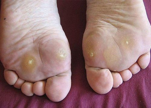 Calluses in people with diabetes - What patients need to know