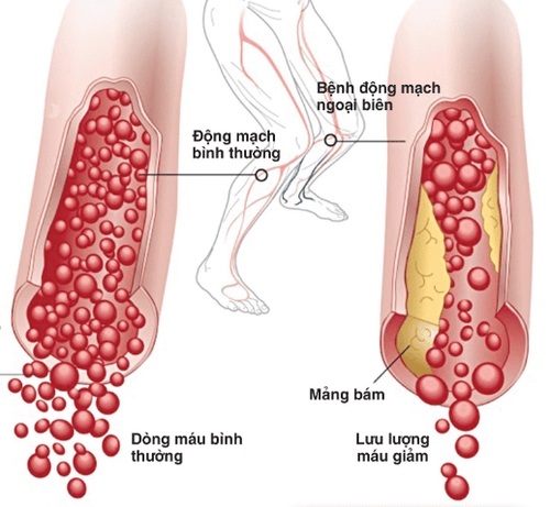 
Bệnh nhân động mạch biên chi dưới sẽ chỉ định bệnh nhân chụp CT mạch máu chi dưới
