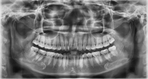 Are dental X-rays harmful?