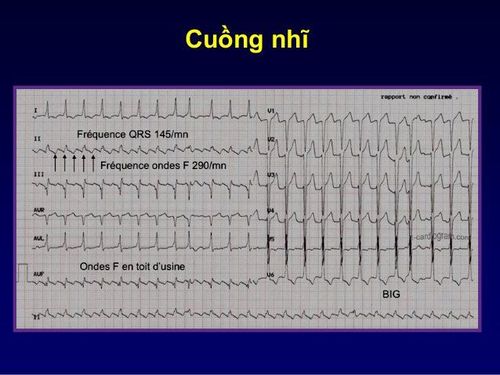 What is tinnitus? Factors that increase the risk of atrial flutter