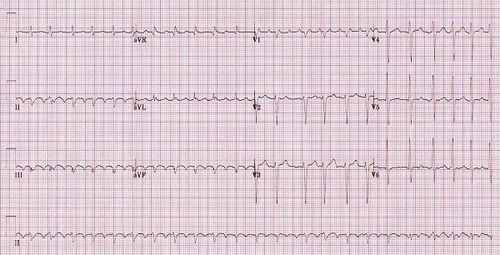 Distinguish between atrial fibrillation and flutter