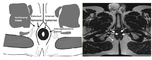 
Phim chụp MRI rò hậu môn
