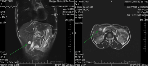 Abdominal magnetic resonance imaging procedure without injection of contrast agent