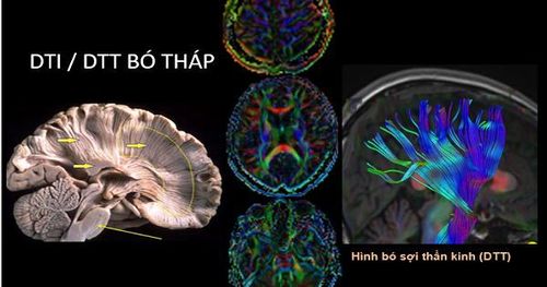 
MRI khuếch tán theo hướng và bó sợi thần kinh (DTI/DTT)
