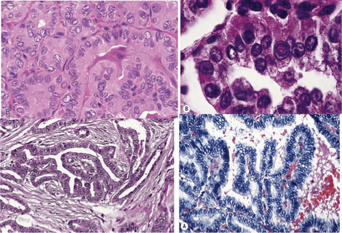 
Hình ảnh carcinôm tuyến giáp dạng nhú (vi thể)
