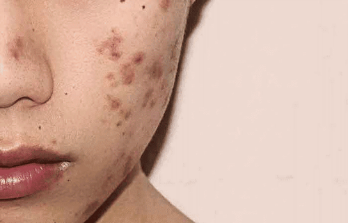 Home remedies for skin pigmentation: How to get rid of dark spots