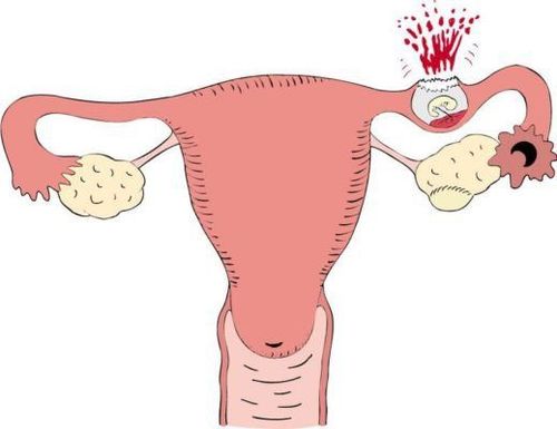 
Gây mê nội khí quản phẫu thuật được chỉ định khi thai ngoài tử cung đã vỡ
