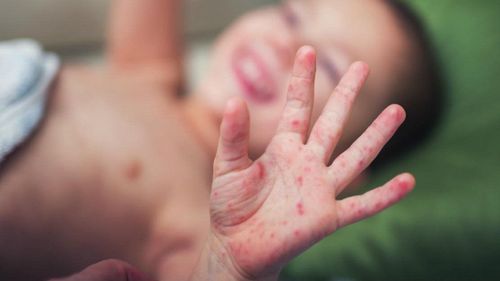 Guidelines for diagnosis and treatment of hand, foot and mouth disease of the Ministry of Health