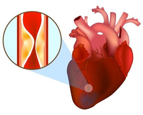 
Nhồi máu cơ tim là một nguyên nhân gây tràn dịch màng tim
