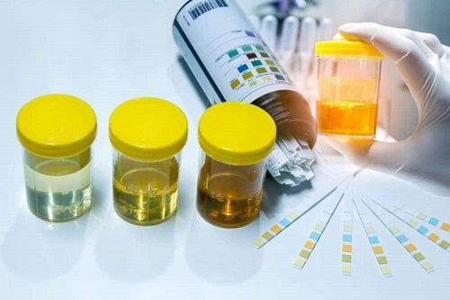 What does Addis sediment test mean?