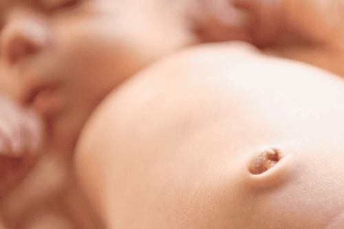 Trẻ sơ sinh tồn tại ống niệu rốn điều trị thế nào?
