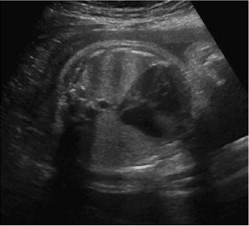 7 weeks pregnant, thin amniotic sac margin, 6mm embryo, 5mm yolk, but no fetal heart, is there still hope?