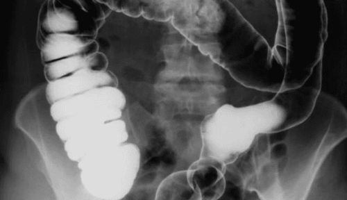 Digital X-ray technique of the small intestine