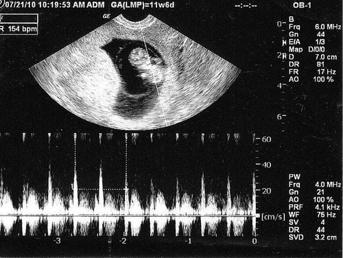 Normal fetal heart images on ultrasound