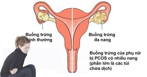 Complications of polycystic ovary