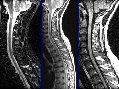 
Trong bệnh lý viêm cột sống dính khớp, MRI chính phương pháp giúp phát hiện tổn thương trên khớp sớm nhất.=
