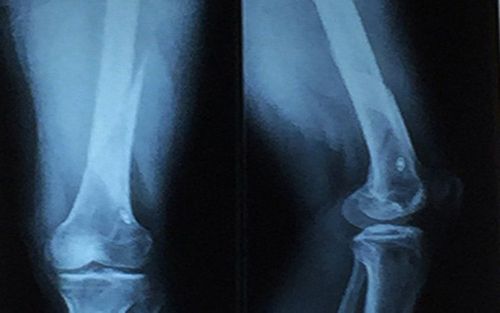 X-ray procedure of straight femur